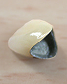 金属のフレームにセラミックを貼り付けた冠