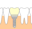 インプラント